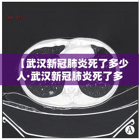 【武汉新冠肺炎死了多少人·武汉新冠肺炎死了多少人口】 【武汉新冠肺炎死了多少人·武汉新冠肺炎死了多少人口】